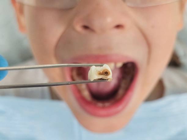 Best Emergency Wisdom Teeth Removal in Combes, TX